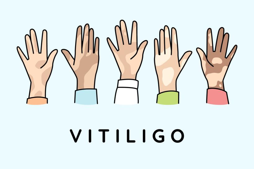 vecteezy diverse hands of people suffer from vitiligo disease people 12983586